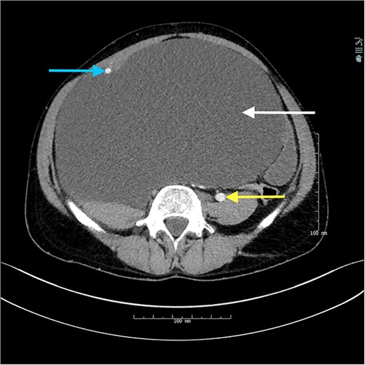 Axial view from abdominal CT showing the retroperitoneal cyst (upper arrow on the right side of the figure) with the displaced right iliac vessels (arrow on the left side of the figure) and the normally positioned left-sided common iliac vessels (lower arrow on the right side of the figure).