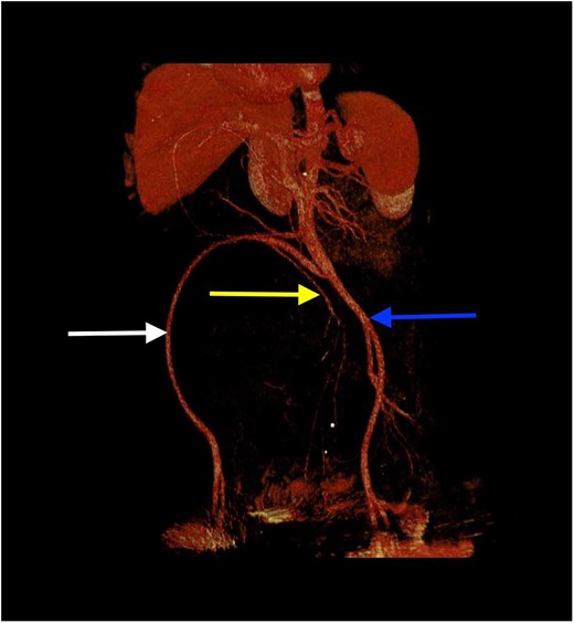 3D reconstruction of the iliac vessels. Right external iliac vessels (arrow on the left side of the figure), right internal iliac vessels (arrow in the middle) and left common iliac vessels (arrow on the right side of the figure).