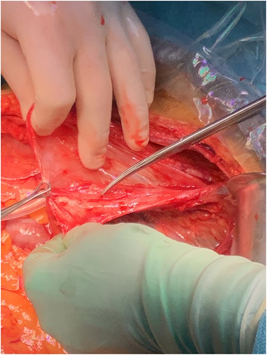 The probe points to the iliac vessels, which were part of the cystic wall (after the cyst had ruptured).