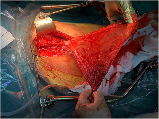 Picture taken immediately before complete surgical excision; the 5-mm pedicle is still adherent to the pubic bone.
