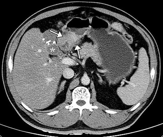 Preoperative contrast abdominal CT scan showed the thickening antral wall with uneven enhancement (white arrows) and a cystic foci (white asterisk) in the gallbladder bed with hyperdense clips from previous cholecystectomy.