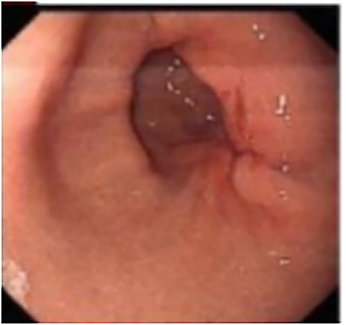 Endoscopy revealed the mucosa of gastric antrum was rough, with convergence of the surrounding folds and deformation on the large curved side of the posterior wall. At the oral side, there was a gentle slope uplift under the mucosa, about 0.6 × 0.8 cm in size.