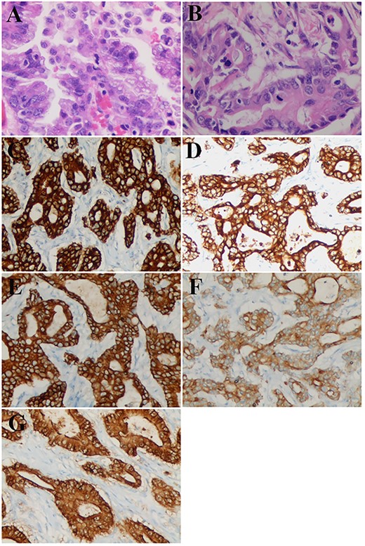 Pathological and immunostaining findings. (A) Remnant cystic duct adenocarcinoma, hematoxylin–eosin staining (×40). (B-G) Adenocarcinoma of the antrum at the greater curvature: (B) hematoxylin–eosin staining (×40). (C) CKAE1 staining (×20): positive. (D) CK7 staining (×20): positive. (E) CK8/18 staining (×20): positive. (F) CK19 staining (×20): weakly positive. (G) Villin staining (×20): positive.