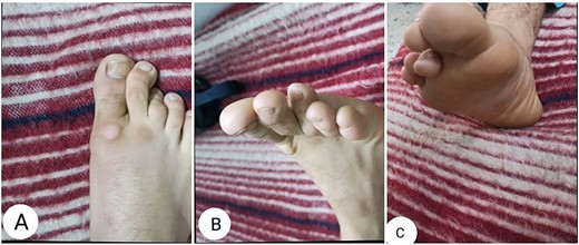 Clinical photographs of the affected foot showing flexion contracture of the third digit.