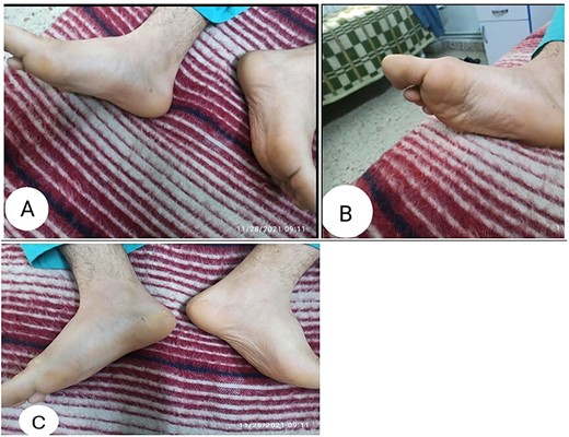 Clinical photographs showing a mass or pseudotumor within the plantar aspect of the right foot.