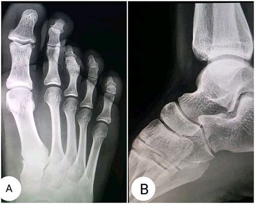X-Ray radiographs showing (A) inferior dislocation of the PIP joint of the third digit; (B) Lateral radiograph showing no abnormalities.