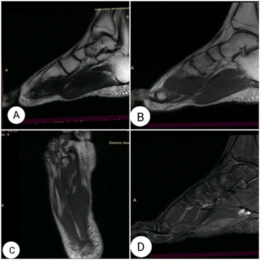 (A) sagittal T2-weighted, (B) sagittal T1-weighted, (C) axial T1-weighted and (D) Short T1 inversion recovery Magnetic Resonance Imaging (STIR) MRI before gadolinium injection.