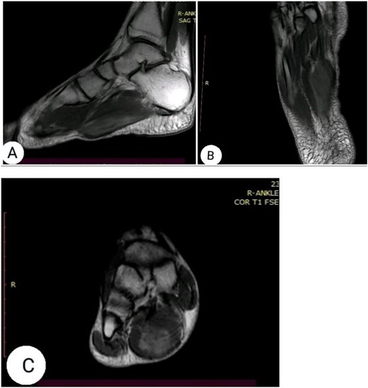 (A) sagittal T1-weghited, (B) axial T1-weighted and (C) coronal T1-weighted MRI following gadolinium injection showing hyperenhancement within the muscle tissue.