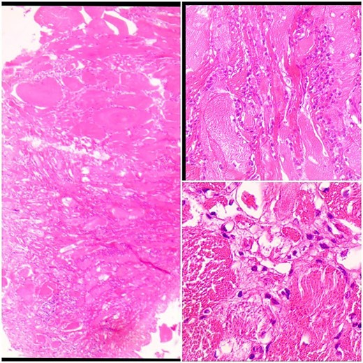 Sections show skeletal muscle fibers infiltrated by inflammatory cells.
