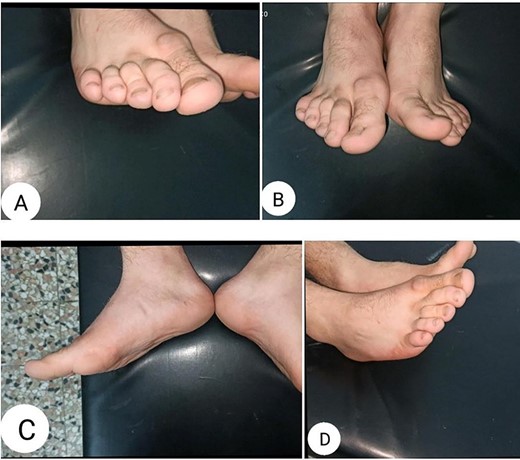 Clinical photographs of the affected foot after 4 months of corticosteroids treatment showing (A, B and D) great resolving of the contracture of the third digit, and (C) almost complete regression of the pseudotumor.