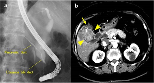 (a) Endoscopic retrograde cholangiopancreatography showing PBM with a Type Ic CBD; the largest diameter of the common bile duct was 17 mm; (b) CECT showing a 47-mm mass with a contrast effect on the gallbladder (arrowhead); the tumor had invaded the S4a/S5 of the liver (arrow).