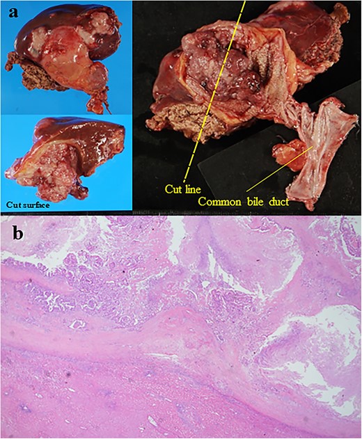 (a) Resected specimen; the liver-invading tumor was observed in the gallbladder (size: 50 × 44 mm); the tumor was exposed on the surface of the liver (b) the histological examination showed moderately differentiated adenocarcinoma (hematoxylin and eosin staining, ×40).