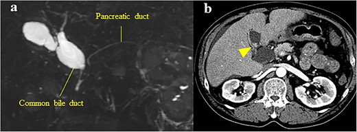 (a) MRCP showing PBM with Type Ia CBD; the largest diameter of the common bile duct was 29 mm; (b) CECT showing an 11-mm mass with a contrast effect in the gallbladder (arrowhead).