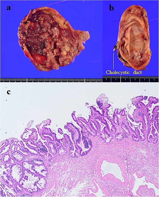 (a) Gallbladder; (b) common bile duct; the tumor was observed in the gallbladder (size: 35 × 30 mm); (c) the histological examination showed well-differentiated adenocarcinoma (hematoxylin and eosin staining, ×100).