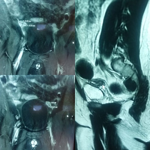 (A) and (B) are radiographic images showing well-defined enhancing areas in the lower abdomen likely to be testes. (C) shows the presence of a soft tissue density structure, i.e. a rudimentary uterus posterior to the urinary bladder.