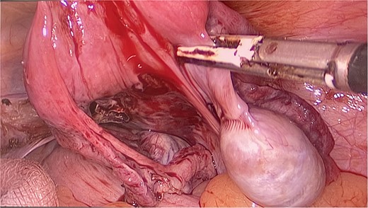 The uterus and testes were visualized in the lower abdomen by a laparoscope. Testes were seen attached to the uterus through the Infundibulopelvic ligament.