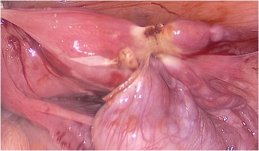 A rope-like band of connective tissue called the round ligament can be seen attaching the uterus to the abdominal wall.