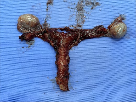 Subtotal hysterectomy and bilateral orchidopexy were performed. A tubular uterus can be seen giving off a suspensory ligament which is connecting the uterus to the testes. A coiled epididymis can also be seen attached to the testes.