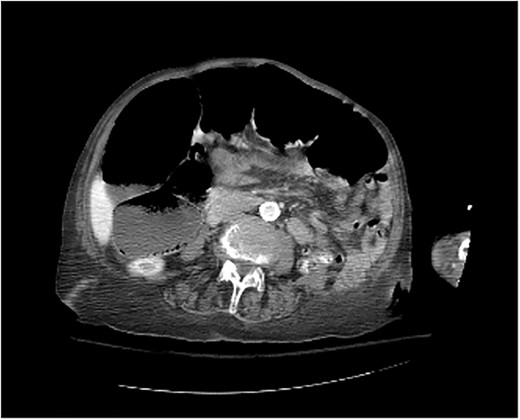 Colonic dilation seen on CT abdomen and pelvis with contrast.