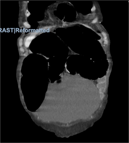 Morgagni hernia seen on CT abdomen and pelvis with contrast.