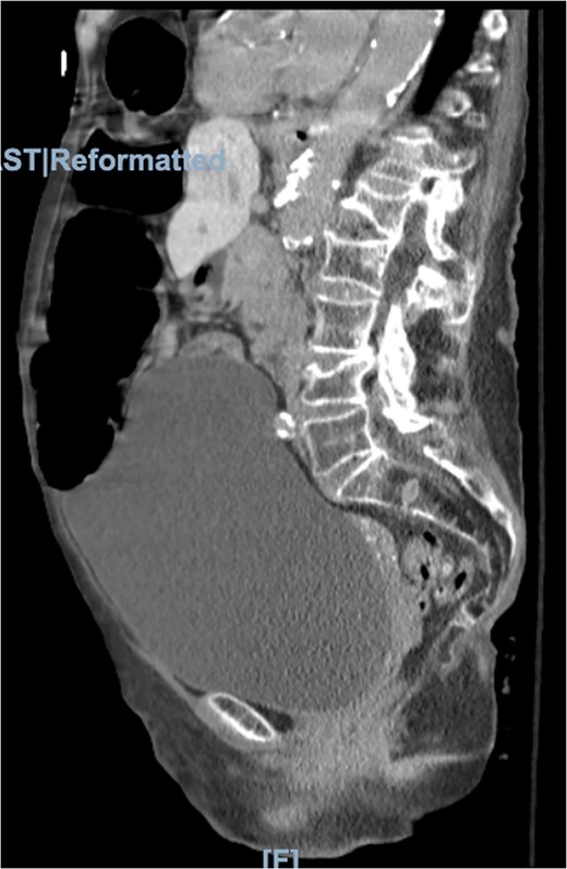 Morgagni hernia seen on CT abdomen and pelvis with contrast (sagittal view).