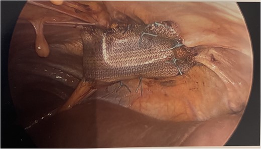 Intraoperative photograph showing Phasix mesh secured across the hernia.