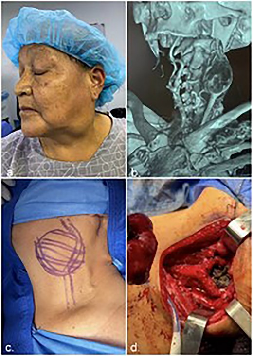 (a) Patient with palpable neck mass (carotid body tumor), (b) CT scan of a patient from the case series, (c)draft of Shamblin classification and (d) observation of CBT commitment.