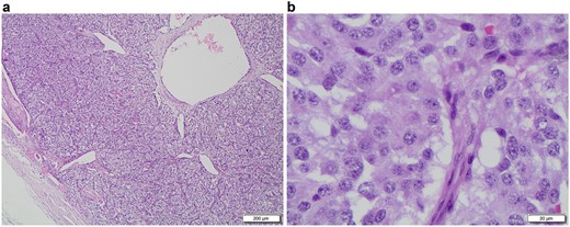 a (G240-22 HE 4x A): a low-power microscopic view of an encapsulated paraganglioma, note the characteristic cell nests called ‘Zellballen’, with tumor cells surrounded by thin-walled vessels; b (F85-22 HE 40x): this high-power view shows the tumor cells with large amounts of oncocytic cytoplasm, round to elongated nuclei with prominent nucleoli and granular chromatin.