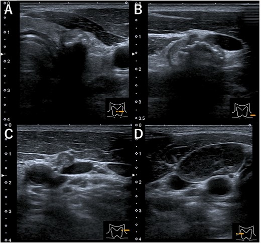 Ultrasonography (A) hypoechoic mass (18 × 14 mm) with microcalcification in the left lobe of the thyroid, (B) mass in the left cervical lymph node (#VI, 18 × 11 mm), (C) mass in the left cervical lymph node (#Va, 5 × 5 mm) and (D) the right cervical enlarged lymph node (#Vb, 24 × 12 mm), hypoechoic internally with no microcalcification.