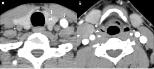 Computed tomography (A) calcified nodules in the left lobe of the thyroid and the left cervical lymph nodes (arrow), (B) the right cervical lymph node mass with no calcification or no contrast effect (arrowhead).