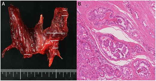 (A) Macroscopic aspect of the thyroid (tumor distribution: solid line), (B) Pathological diagnosis of papillary thyroid carcinoma. Hematoxylin and eosin staining, 200×.