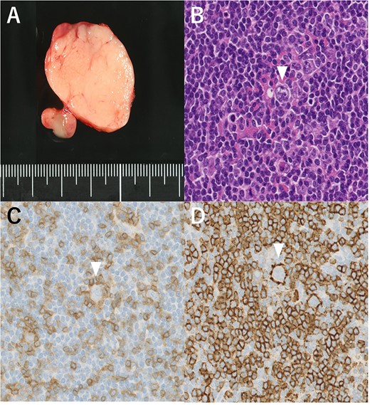 (A) Macroscopic aspect of the right cervical lymph node (#Vb). (B) Lymphocyte-predominant cells, termed “popcorn cells” (arrowhead) were observed against a background of B-cell-rich lymphoid follicles. Hematoxylin and eosin staining, 200×. (C) Immunostaining CD3 (–), 200×. (D) CD20 (+), 200×.