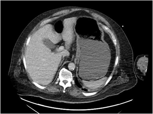Initial CT of the abdomen and pelvis: gastric pneumatosis.