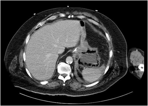 Repeat CT of the abdomen and pelvis: decompression of the stomach with persistent gastric pneumatosis.