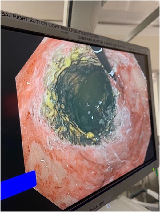 Intraoperative endoscopic image: necrotic gastric fundus.