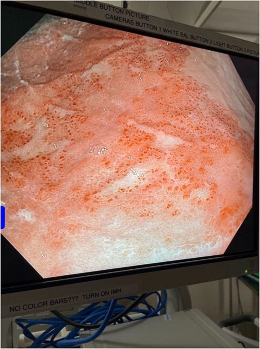 Intraoperative endoscopic image: inflammatory changes of gastric mucosa in midbody of stomach.