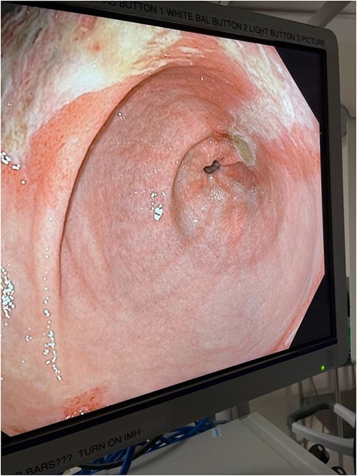 Intraoperative endoscopic image: inflammatory changes of gastric mucosa in antrum of stomach.