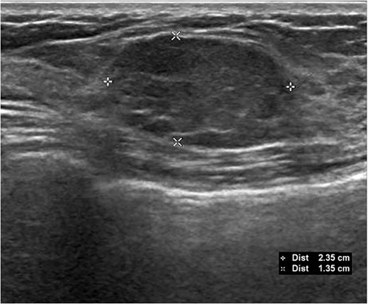 Initial ultrasound demonstrating the left breast mass measuring 2.4 × 2.5 × 1.4 cm. Core needle biopsy of this mass showed benign fibroadenoma with no malignancy.