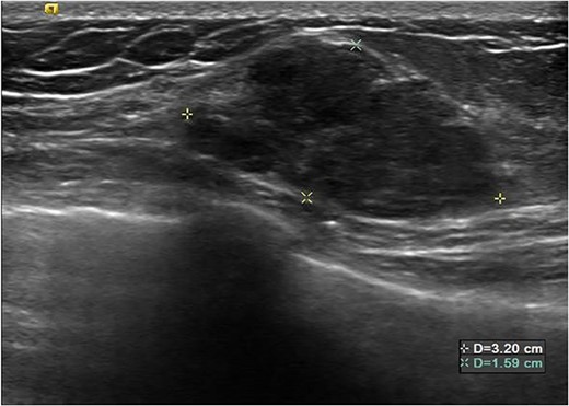 Subsequent ultrasound demonstrating increase in size of the left breast mass now measuring 3.2 × 2.7 × 1.6 cm. There was also new development of irregular margins, giving an indeterminate appearance.