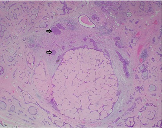 Photomicrograph showing a few ducts within the fibroadenoma expanded by a monotonous epithelial proliferation of classic lobular carcinoma in situ (arrows). (HE, ×20).