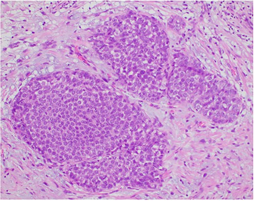 Photomicrograph showing the expanded ducts by classic lobular carcinoma in situ. (HE, ×200).