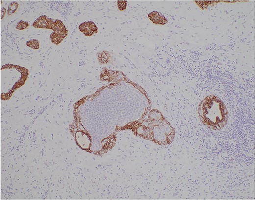 Photomicrograph of the classic lobular carcinoma in situ showing negative E-cadherin membranous staining. (E-cadherin, ×100).