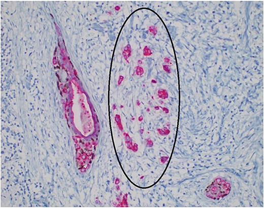 Photomicrograph showing a focus of microinvasive carcinoma (circle). (AE1/AE3/p63, ×400).