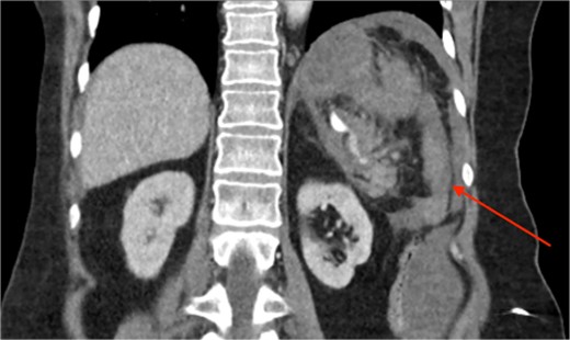 CT of the abdomen and pelvis, coronal plane, arterial phase. Large intraabdominal haematoma in the left upper quadrant.
