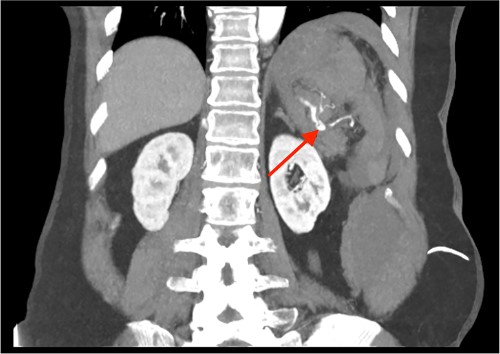 CT of the abdomen and pelvis, coronal plane, arterial phase. Contrast extravasation from the ruptured SAP.