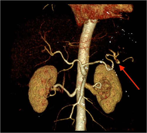 CT angiography of the abdomen with 3D reconstruction. Ruptured SAP.