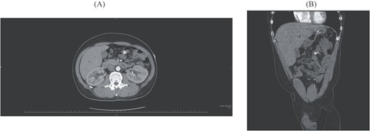 (A) Axial image of CE-CT shows a round, hypervascular nodule. (B) Coronal image shows vascular dilatation in the mesentery close to the nodule.