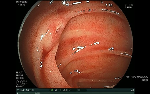 DBE shows a tiny mucosal break with pulsatile submucosal uplifting in the jejunum.