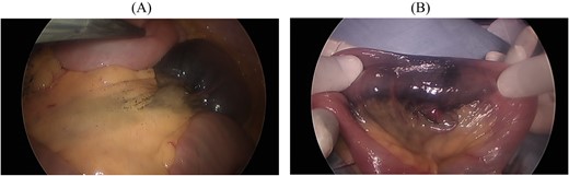 (A) Laparoscopy easily shows the tattooed jejunum. (B) Gross findings show dilated pulsatile vessels in the mesentery.