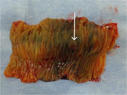 Gross findings of the resected specimen show no abnormal wall changes except for a tiny mucosal break in the jejunal mucosa (arrow).